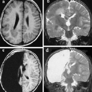 半侧巨脑症：临床意义和外科治疗