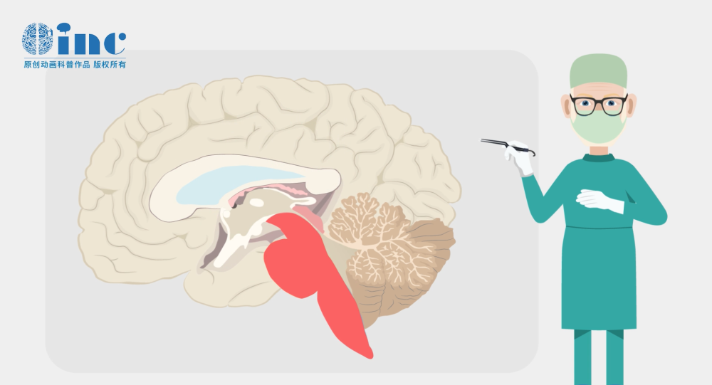 脑干胶质瘤孩子怎么护理？儿童脑干上胶质瘤严重吗？