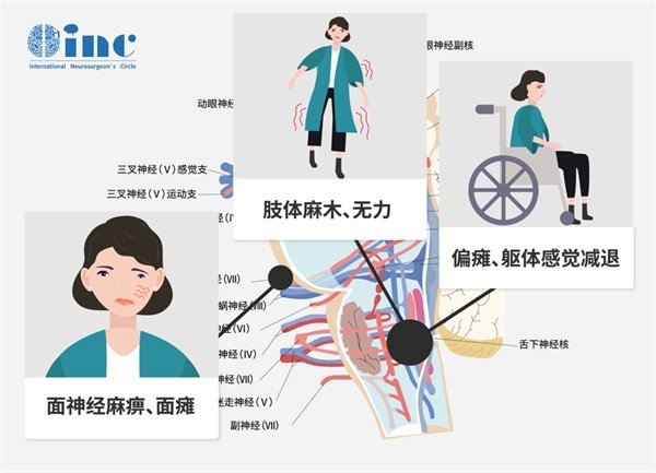 脑海绵状血管瘤的临床表现