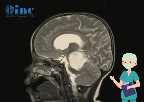 脑干胶质瘤建议手术吗多少钱