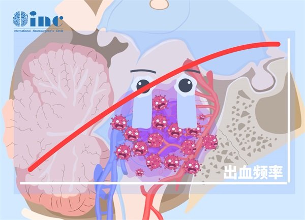 左侧脑海绵状血管瘤严重吗