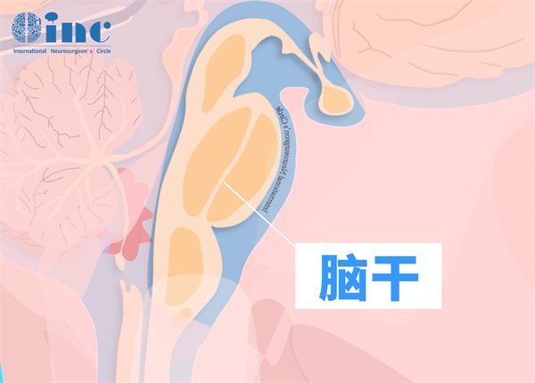 延髓海绵状血管瘤中医治疗方法