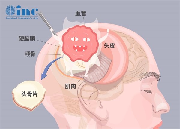 非典型脑膜瘤who2级能活多久