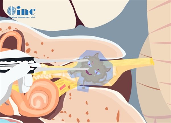 左侧听神经瘤临床表现图片