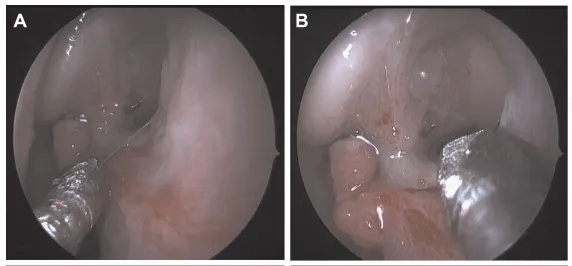 中鼻甲（MT）侧移后，鼻腔探查右鼻窝，证实鼻中隔有大穿孔，黏膜呈白色（图A和B）。
