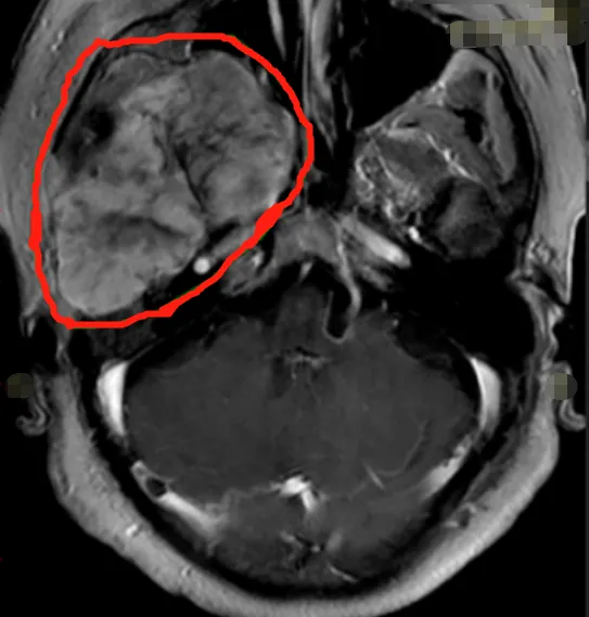 脑膜瘤案例