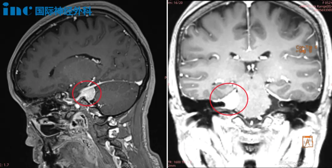 脑膜瘤案例