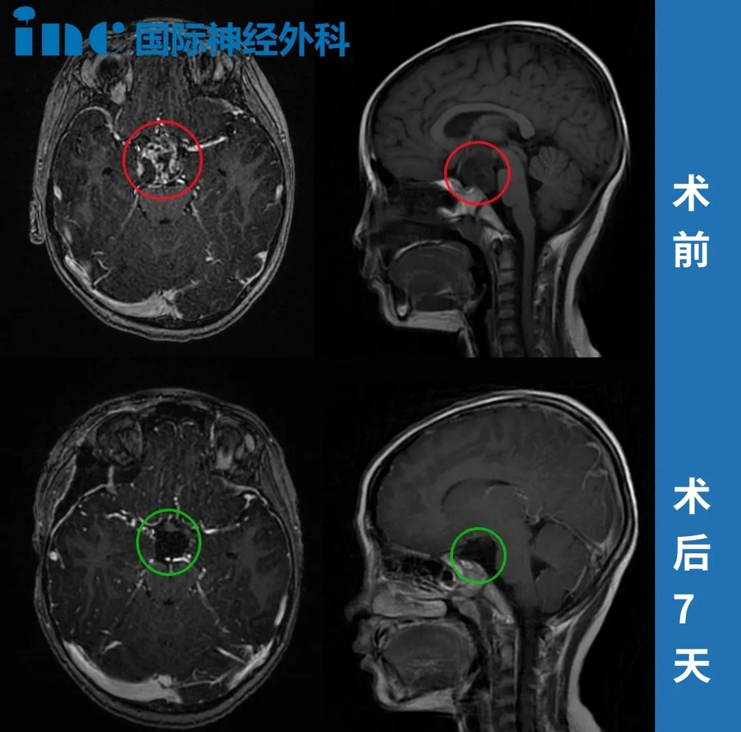 鞍区肿瘤，颅咽管瘤