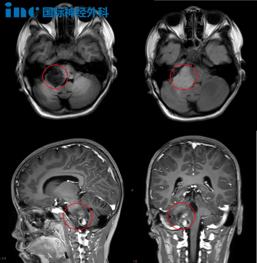 6岁男孩——脑干-延髓毛细胞星形细胞瘤术后影像