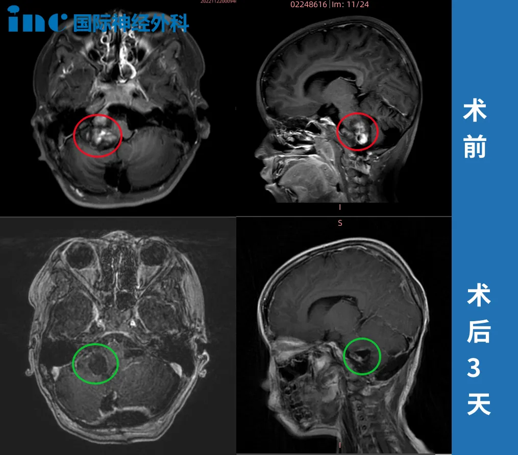 6岁男孩——脑干-延髓毛细胞星形细胞瘤