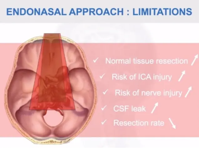经鼻内镜入路局限性