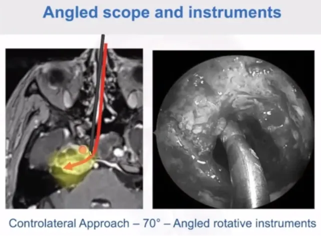 下图可以看到这是一个70度镜，这个角度可以进入很深的位置，可以在梅克尔腔下面去吸除肿瘤，从这个位置可以向外侧去，这是一个很好的选择。