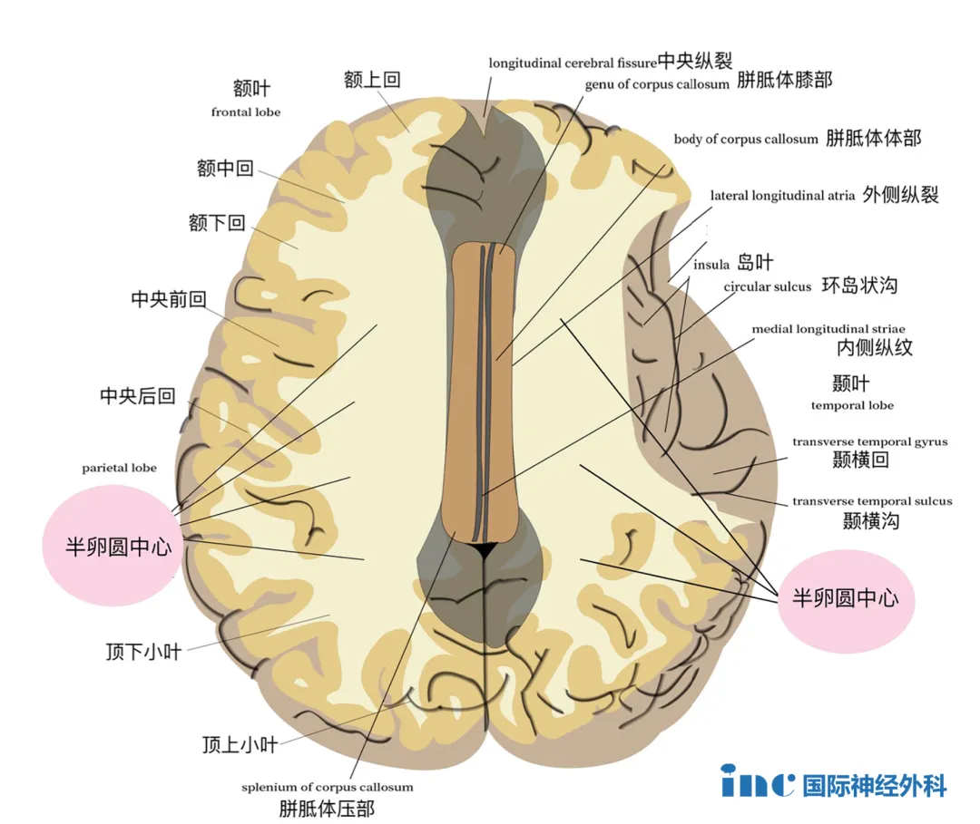 功能区海绵状血管瘤手术