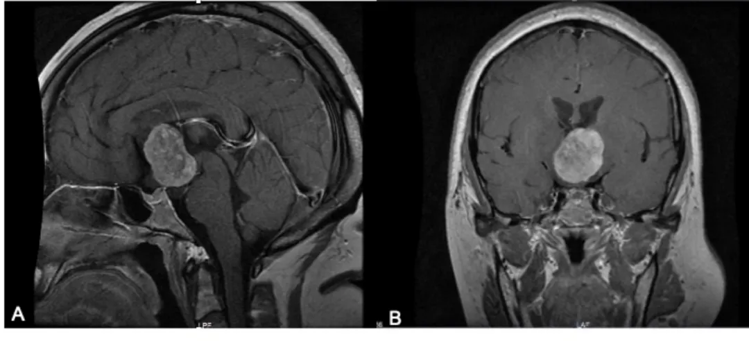 头颅MRI增强扫描示鞍上占位，边界较清。T1WI呈等低信号，T2WI呈不均匀等高信号，增强后病灶呈不均匀强化，邻近侧脑室、三脑室、视神经受压。A示增强矢状位，B示增强冠状位。