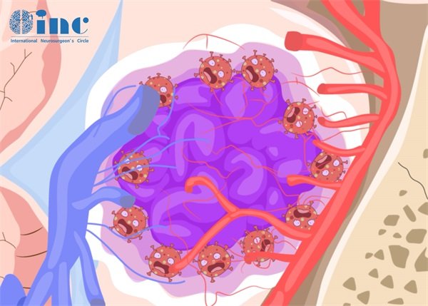 脑血管海绵状血管瘤介入