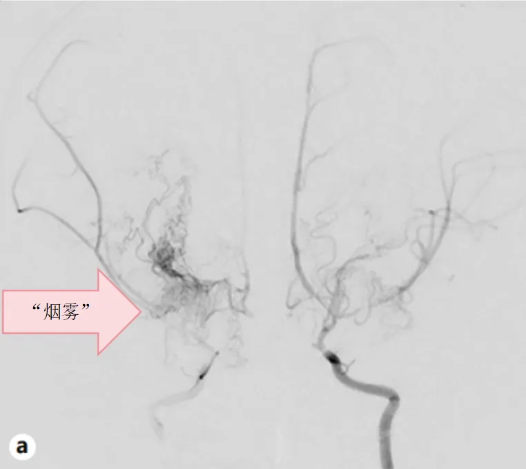 图1.a双侧CTA显示左侧颈内动脉血管严重狭窄，颈内动脉的末端前部和中部的动脉和起源可见于两侧的脑动脉，还可以看到“烟雾动脉。