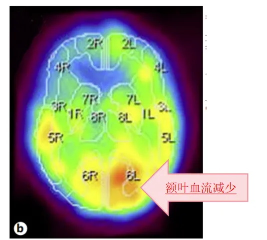 右侧额叶明显的脑血流减少、代谢低，提示既往脑梗病史。