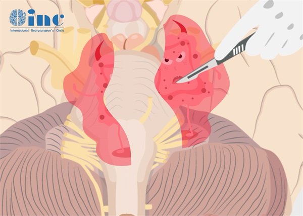 脑干胶质瘤从哪里手术好?