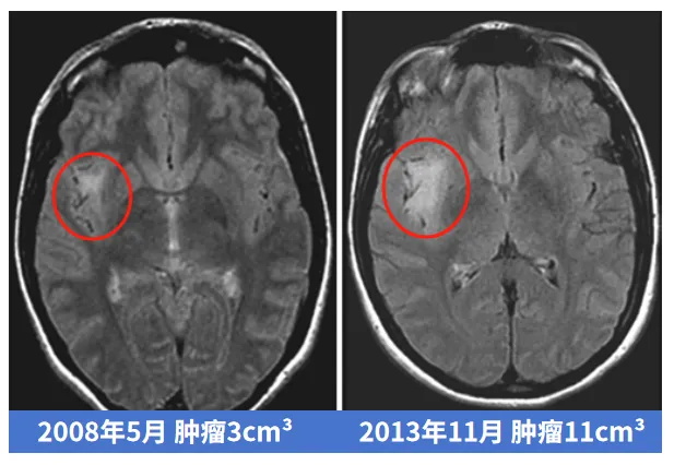 肿瘤发展进程变化