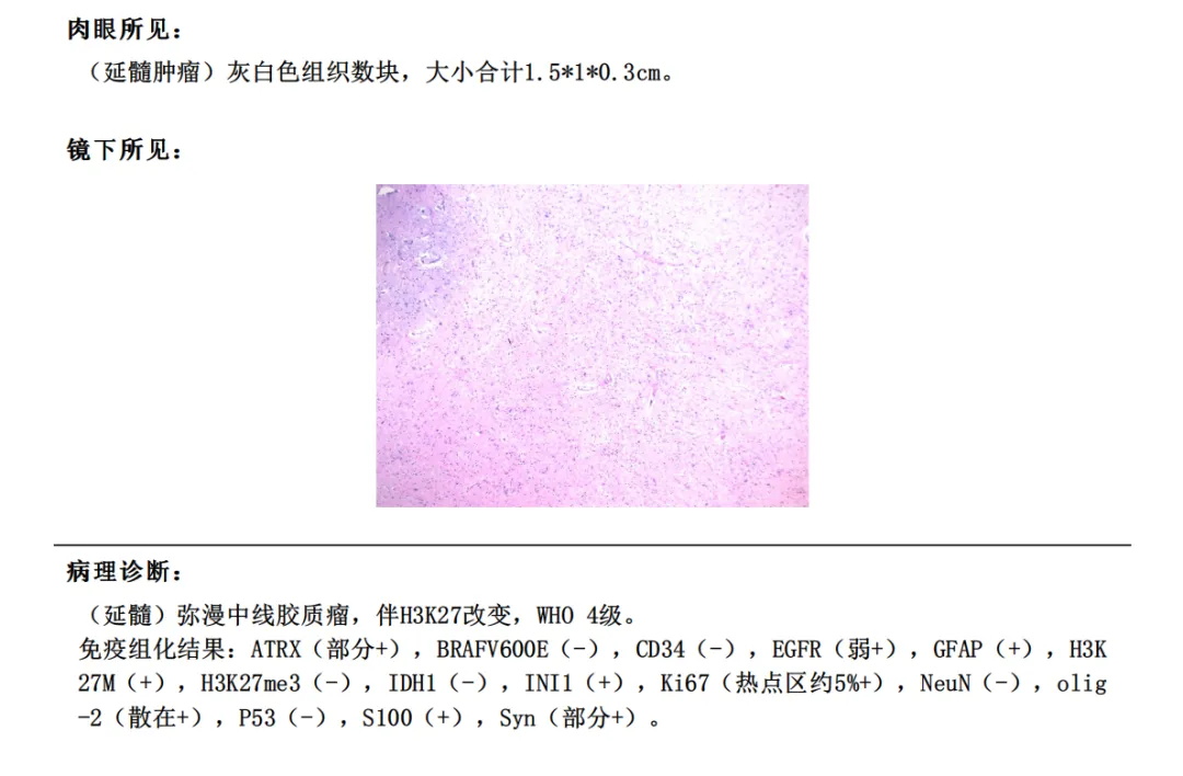 49岁男性-低级别胶质瘤术后竟是四级