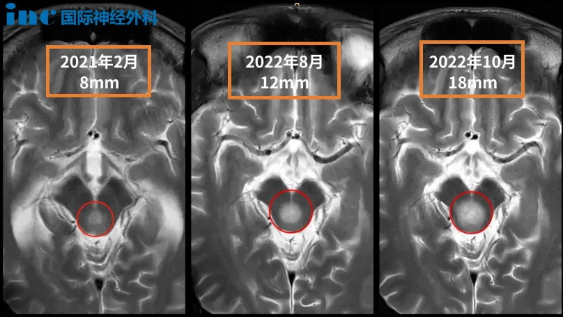 21岁男性-脑干低级别胶质瘤，2个月迅速生长8mm