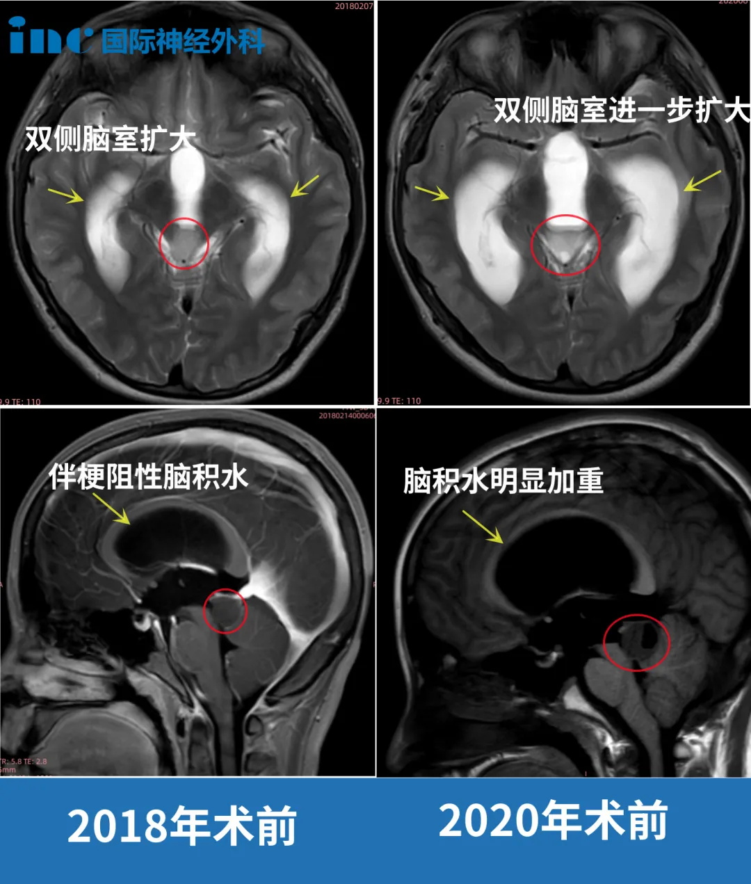 14岁男孩-脑干胶质瘤2年压扁脑干导致脑积水