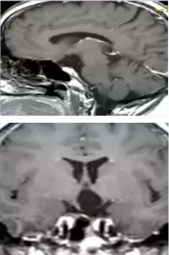 术后MRI，显示解剖性全切除