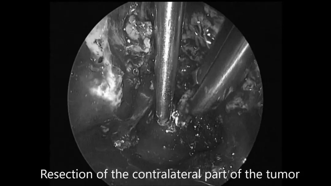 “筷子技术”神经内镜切除对侧肿瘤