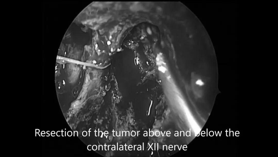 “筷子技术”神经内镜切除侵犯对侧副神经的脊索瘤