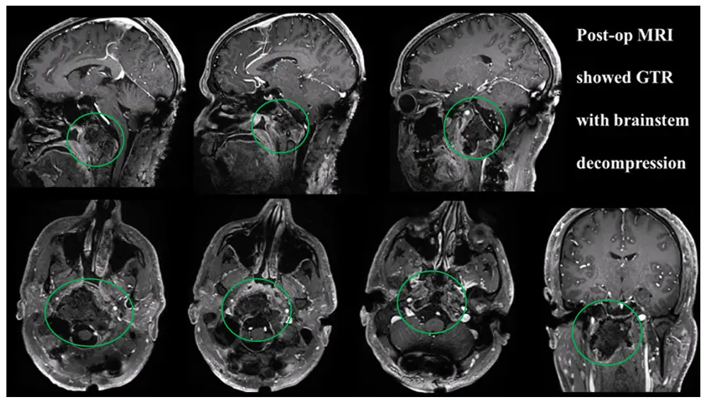 术后MRI显示肿瘤完全切除，且脑干解压