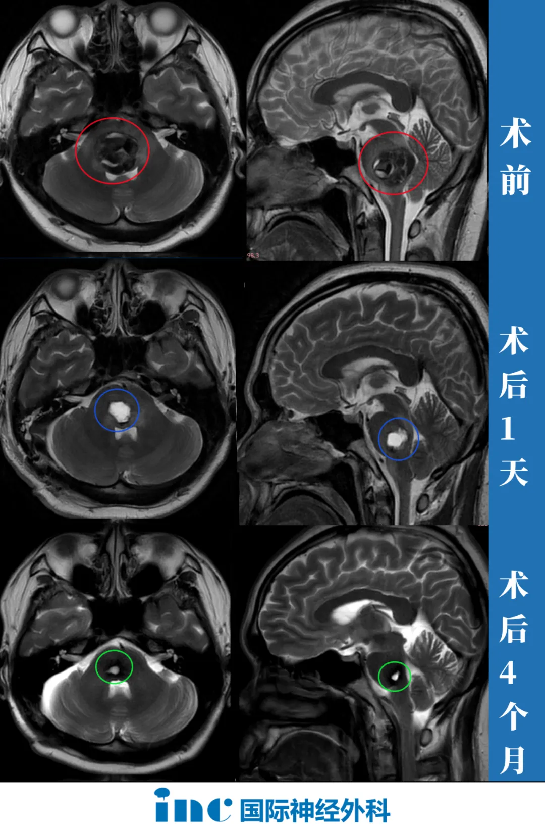 脑干海绵状血管瘤患者术前术后影像对比图片