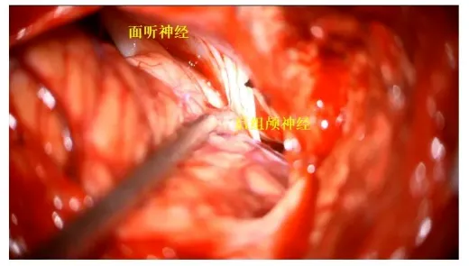 充分显露后组颅神经、面听神经及绒球