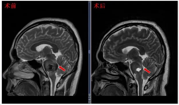 术后患者MRI显示面丘结构恢复