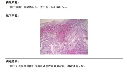 术后患者MRI显示面丘结构恢复