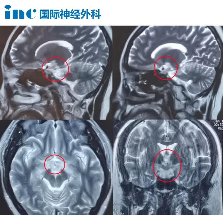 下丘脑病变为何活检无法确诊？