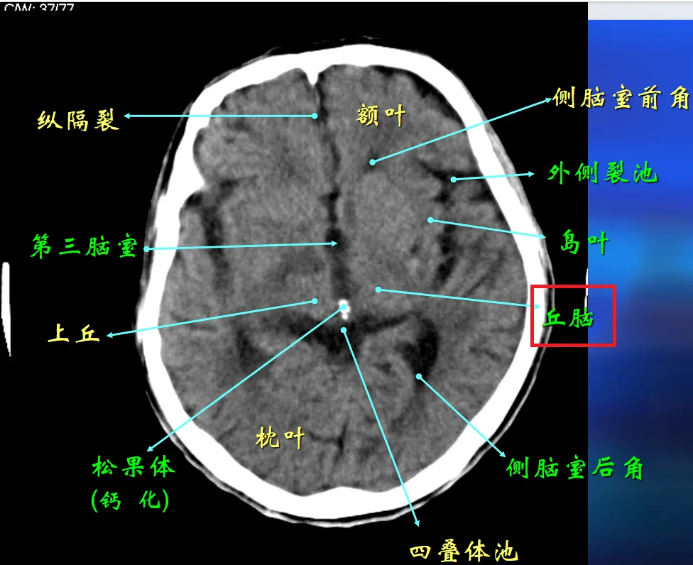 丘脑附近重要的邻居有松果体、下丘脑、中脑。