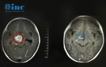 5岁患儿视神经下丘脑胶质瘤