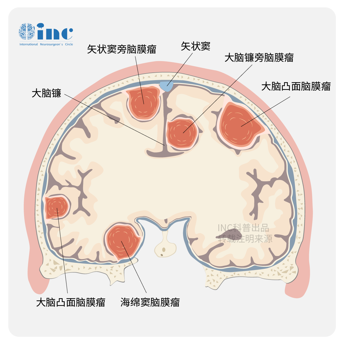 矢状窦旁脑膜瘤图片