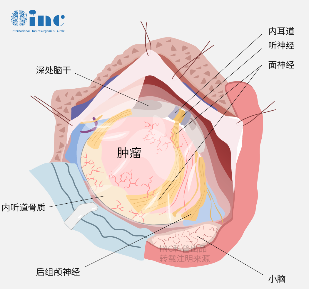 CPA桥小脑角区肿瘤图片