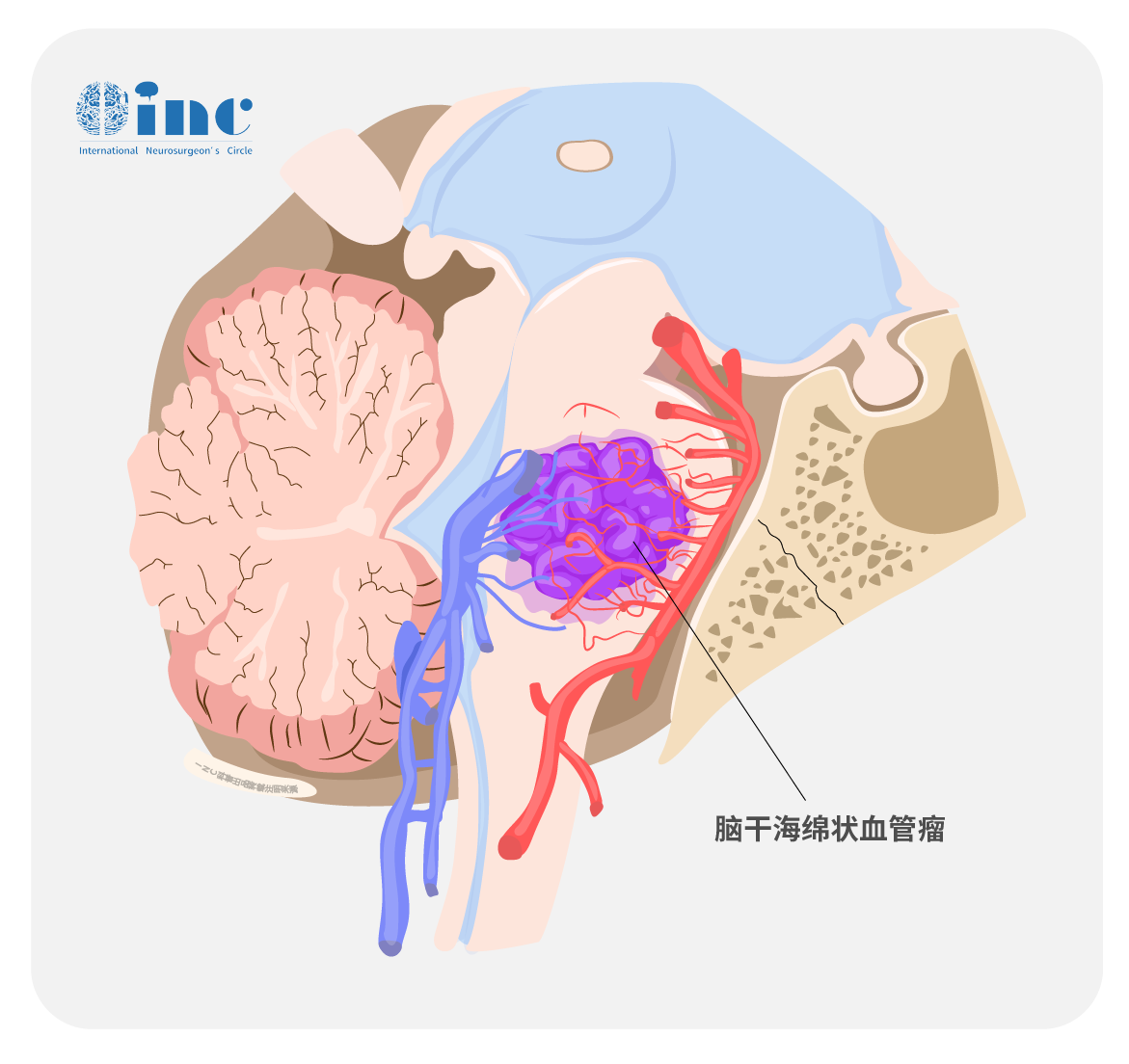 脑干海绵状血管瘤图片