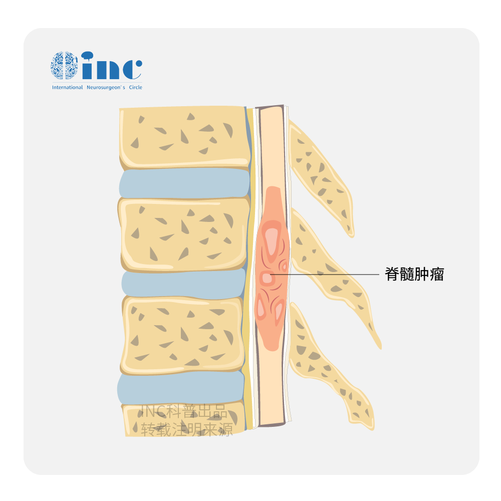 脊髓肿瘤图片