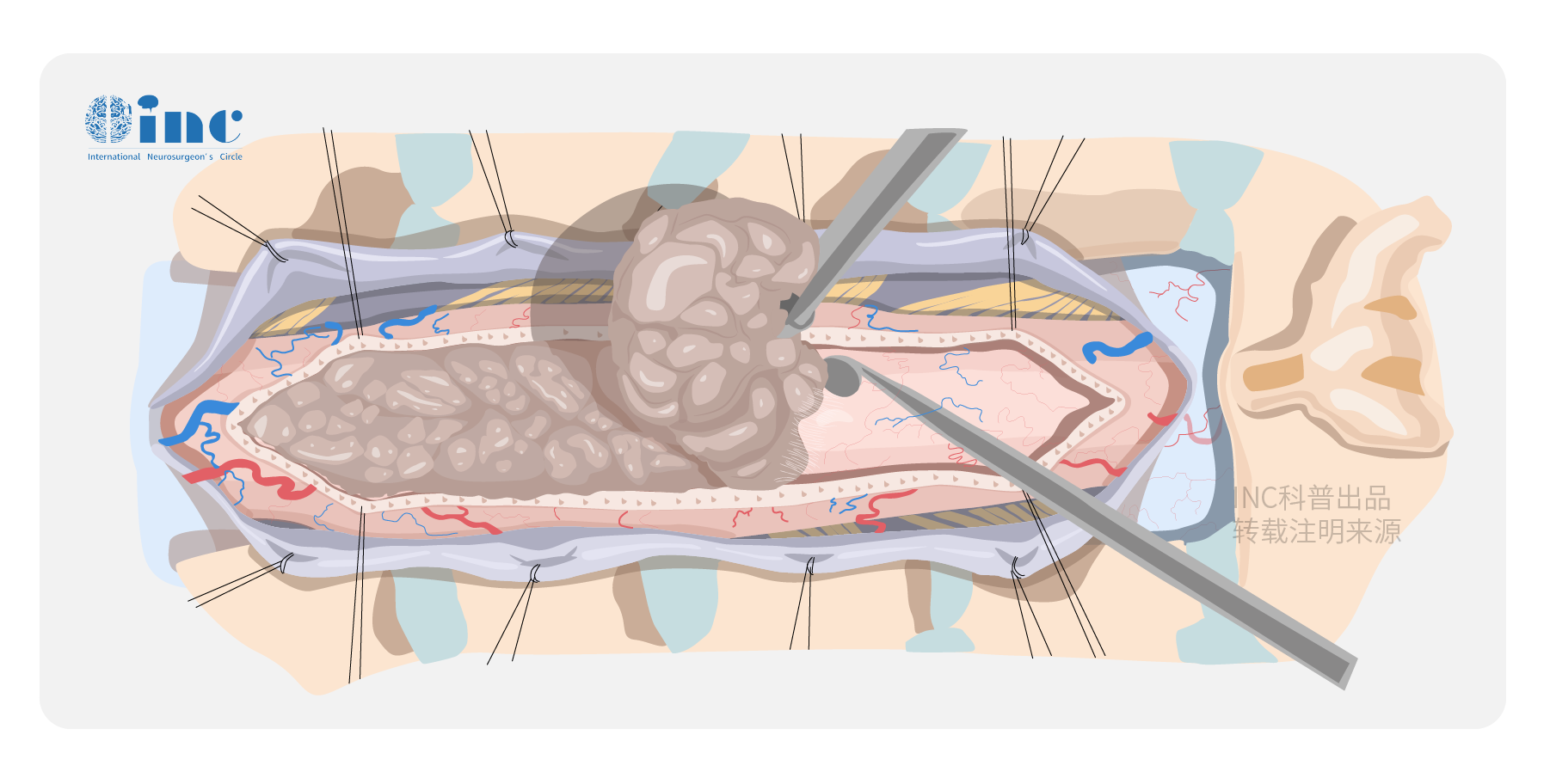 脊髓肿瘤手术图片