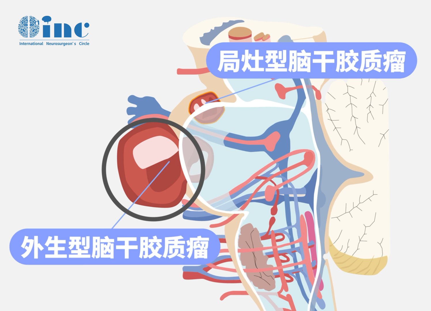 外生型脑干胶质瘤图片