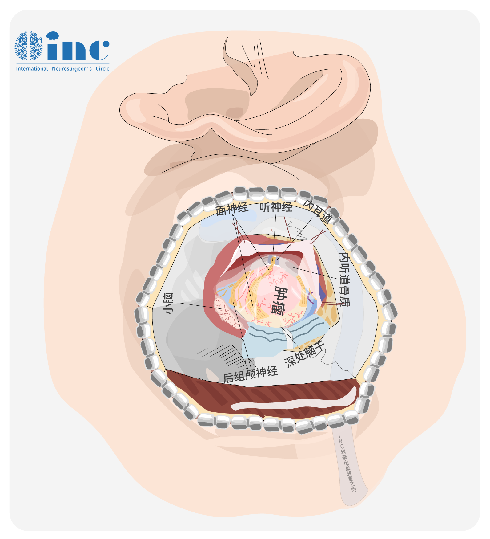 乙状窦后入路切除<a href='/bingzhong/tsjl/' target='_blank'><u>听神经瘤</u></a>图片