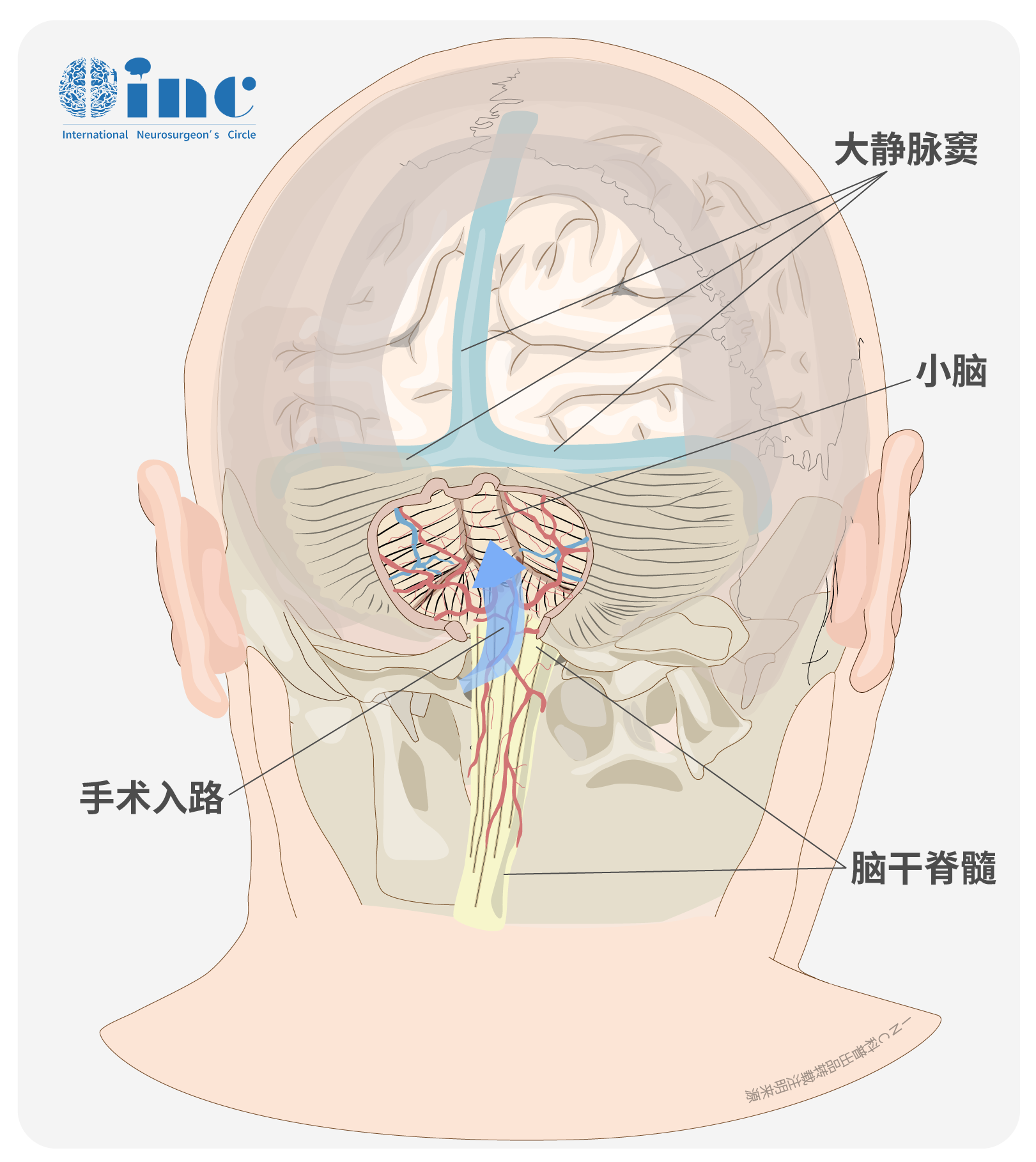 髓帆入路图片