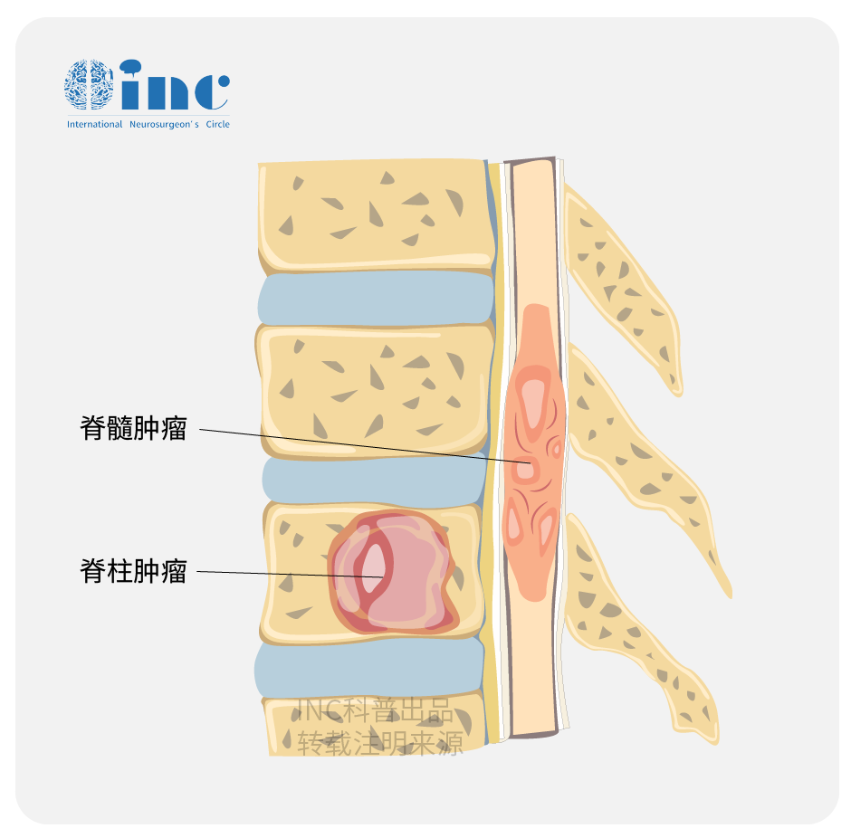 脊柱肿瘤图片