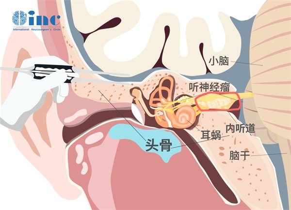 听神经瘤可以做人工耳蜗吗