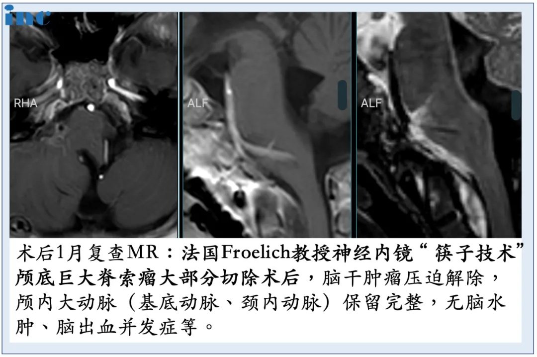 较大脊索瘤案例