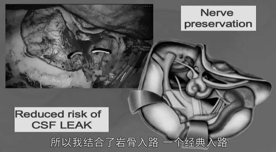 案例一：高MBI肥胖患者硬膜内脊索瘤，手术中可能会出现严重的脑脊液漏