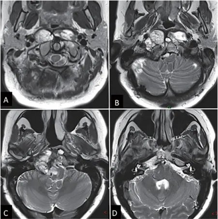 图1：内镜下鼻内镜入路前的术前影像。(A-D)MRI T2 WI显示一个较大脊索瘤延伸至椎前间隙和齿状突周围。肿瘤横向延伸至舌下管和颈静脉孔，并向内侧延伸至硬膜内间隙。肿瘤从斜坡中部延伸至枢椎齿状突周围。